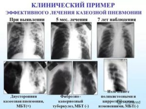Как отличить туберкулез от бронхита