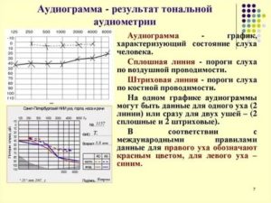 Расшифровка аудиограммы слуха