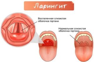 Восстановление слизистой горла