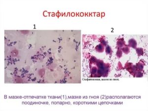 Кокковая флора в носу у ребенка