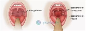 Чем снять отек горла у ребенка