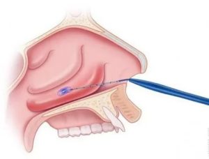 Радиоволновая дезинтеграция нижних носовых раковин