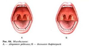 Гиперемия зева фото