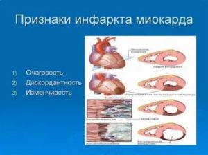 Одышка после инфаркта миокарда лечение