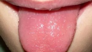 Сыпь на языке у ребенка фото