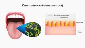 Запах гноя изо рта причины