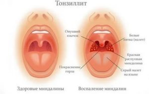 У ребенка постоянно першит в горле причины