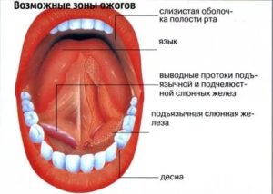 Химический ожог слизистой рта лечение