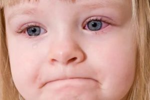 У ребенка высокая температура и гноятся глаза