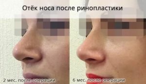 Отек после ринопластики кончика носа