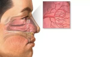 Слабые сосуды в носу лечение