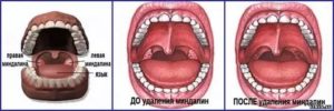 Удаление гланд плюсы и минусы