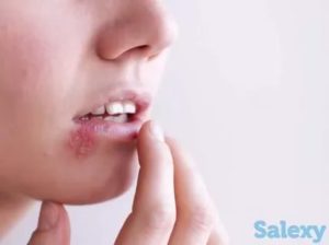 Простуда на лице фото как лечить