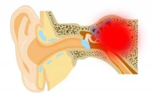 Ушная инфекция симптомы