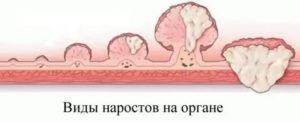 Полипы в головном мозге