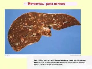 Рак легкого с метастазами в печень