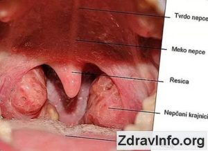 Опухоль миндалины фото