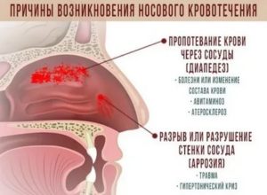 Идет кровь из носа при беременности причины