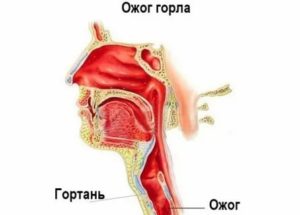 Чем лечить обожженное горло