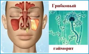 Грибок в гайморовой пазухе