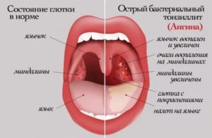 Что значит рыхлое горло у ребенка