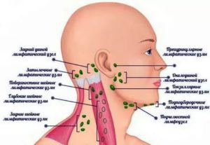 Воспаление подъязычного лимфоузла