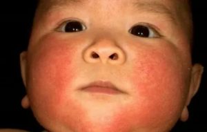 Температура при аллергии у детей комаровский