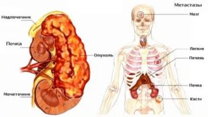 Рак почки метастазы в легкие сколько живут