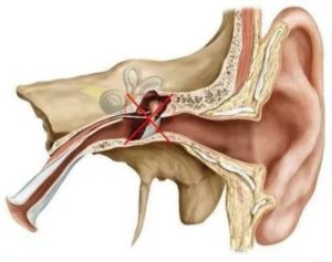Сколько восстанавливается слух после отита