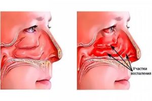 Насморк в одной ноздре не проходит