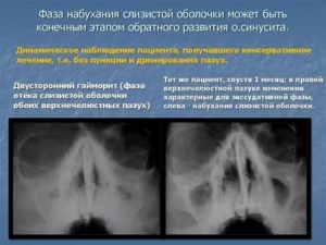 Пристеночный отек слизистой верхнечелюстной пазухи