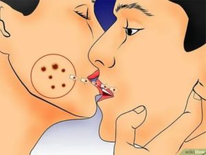 Заразен ли герпес на губах при поцелуи