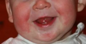 Красные щеки у ребенка причины комаровский