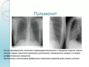 Пульмонит что это такое
