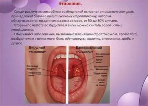 Возбудитель тонзиллита