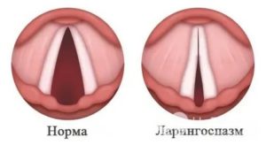 Спазм гортани причины у взрослых