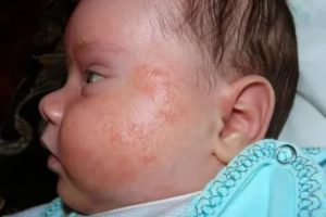 Аллергия у детей до года комаровский