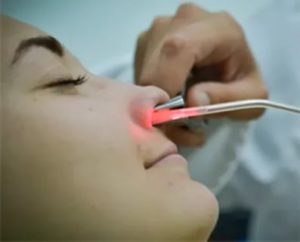 Лазерное лечение носа