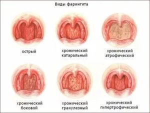 Стрептококковый фарингит симптомы