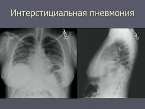 Интерстициальный пневмонит симптомы