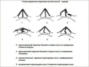 Сломанный нос какая степень тяжести