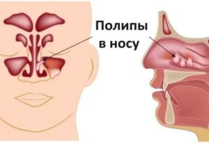 Полипы в гайморовой пазухе лечение