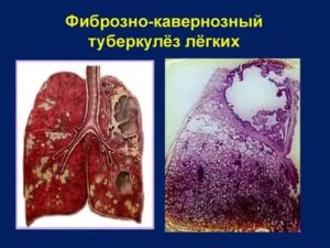 Фиброзно кавернозный туберкулез легких заразен или нет