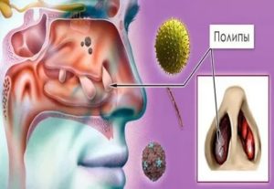 Полипозный риносинусит лечение народными средствами