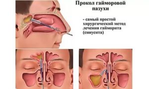 После прокола гайморовых пазух заложенность носа