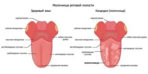 Кандидозы у мужчин лечение во рту