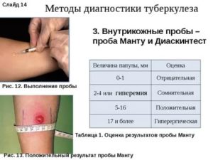 Можно ли делать диаскинтест при кашле