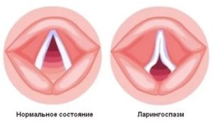 Спазм гортани причины у взрослых