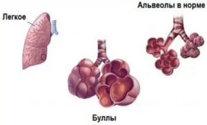 Буллы в легких причины