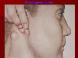 Двусторонняя аксиллярная лимфаденопатия